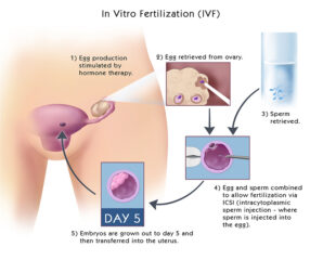 IVF Procedure Steps